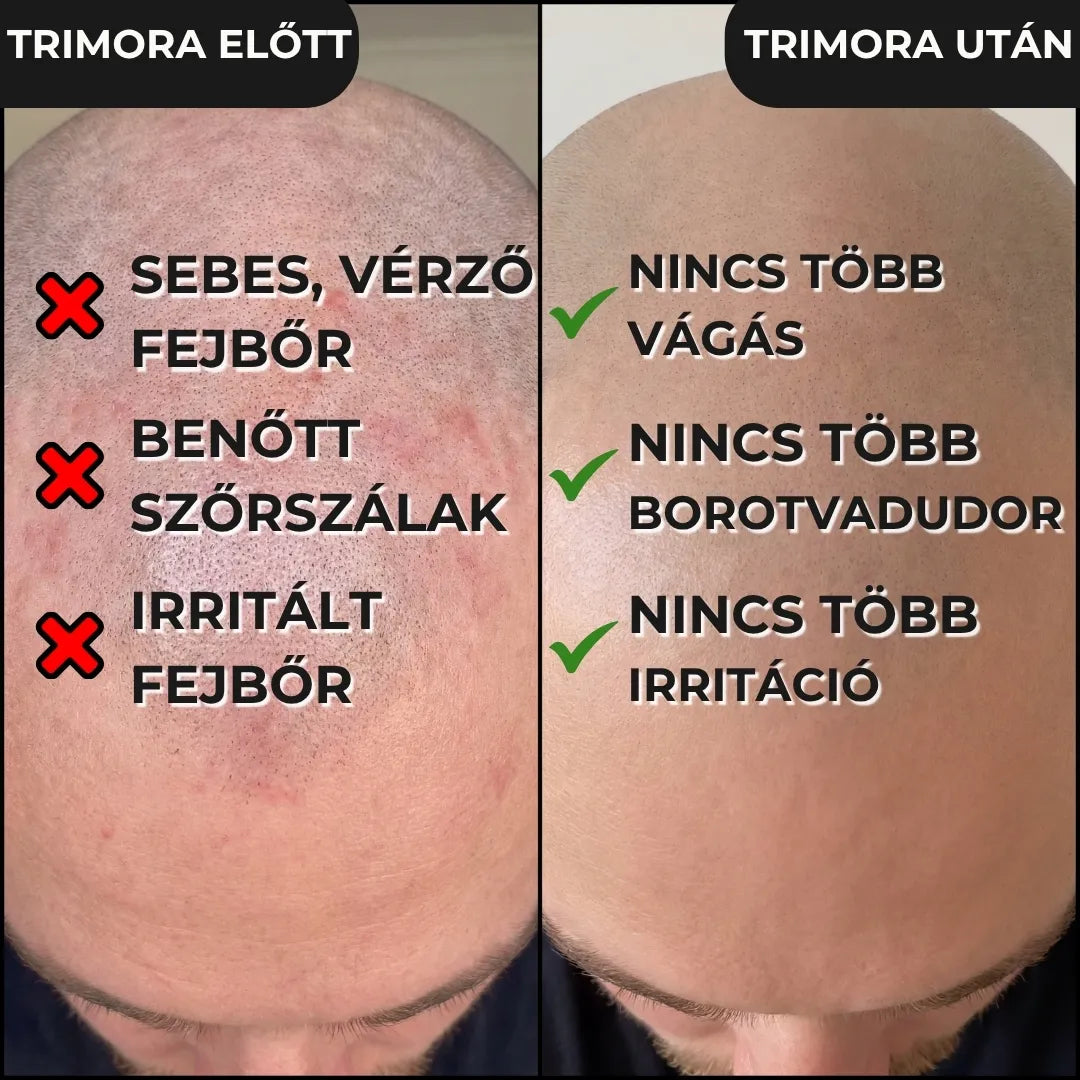 Trimora™ 5 az 1-ben elektromos borotva